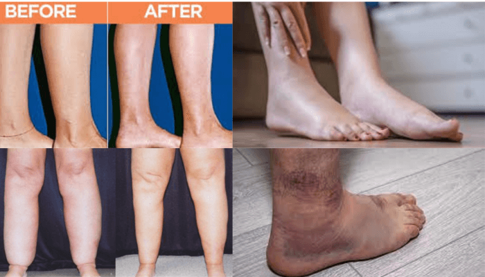 Cankles before and after image