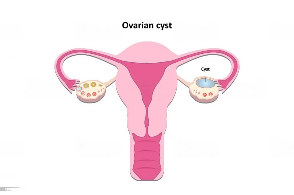 Will I Lose Weight When They Remove Ovarian Cyst?