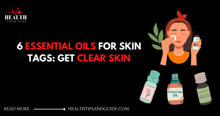 Essential Oils For Skin Tags That Naturally Removes Moles